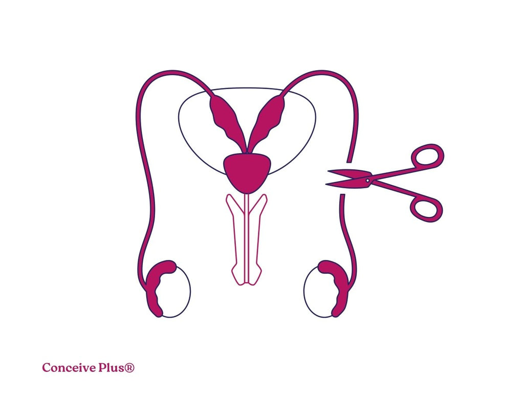 A Simple Guide to Vasectomy Medical Term and Procedure - Conceive Plus®