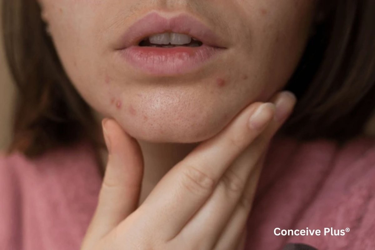 Is Acne a Sign of Pregnancy? - Conceive Plus®